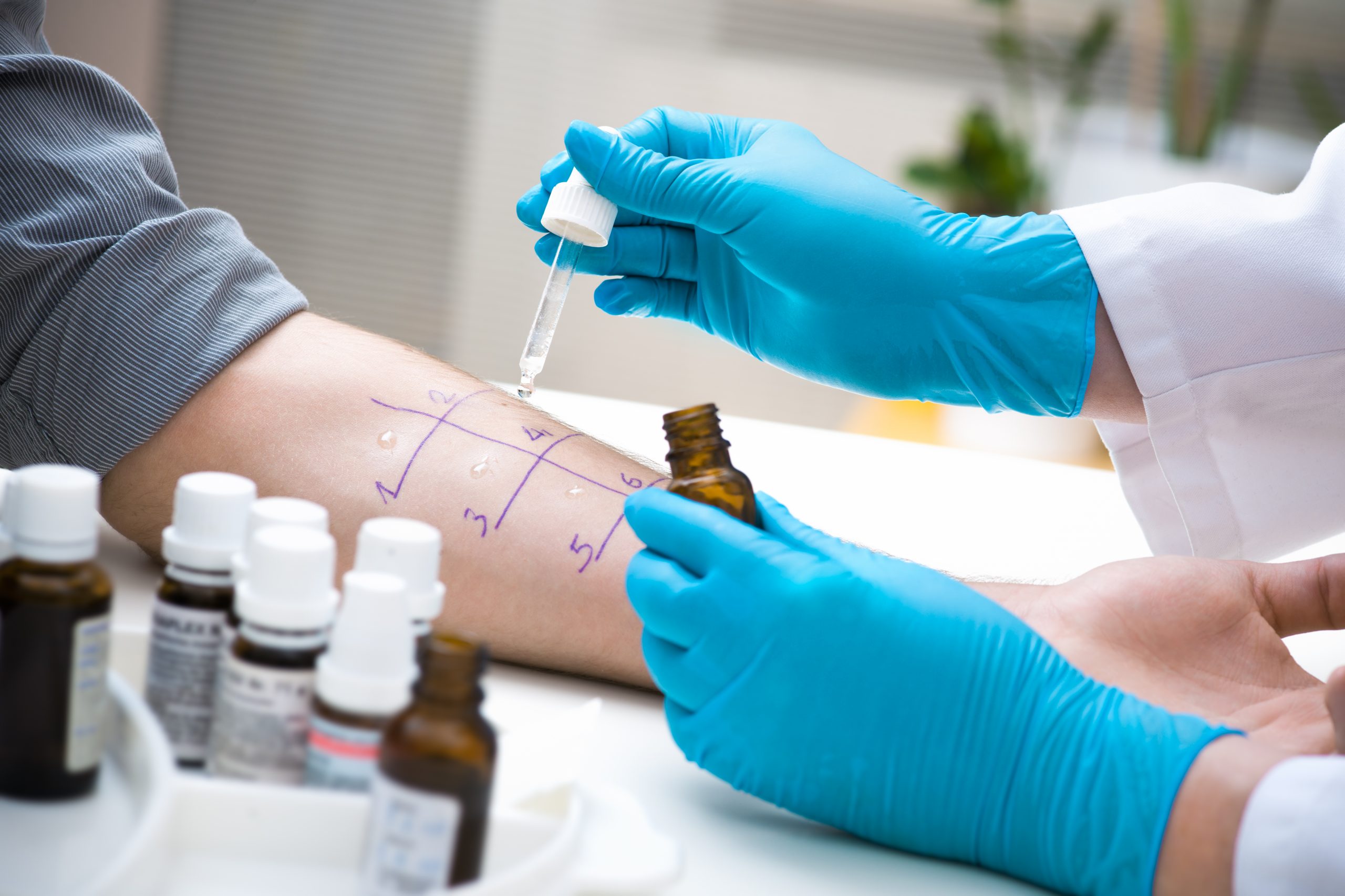 Tipos de alergia e seus sintomas Tipos de alergia e seus sintomas
